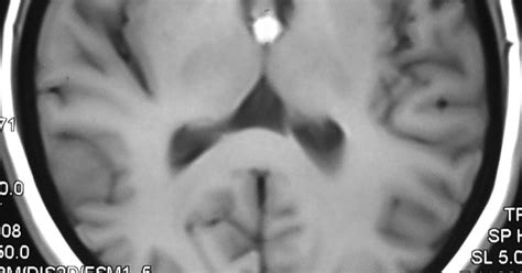 Radiodiagnosis - Imaging is Amazing-Interesting cases: Colloid cyst - MRI