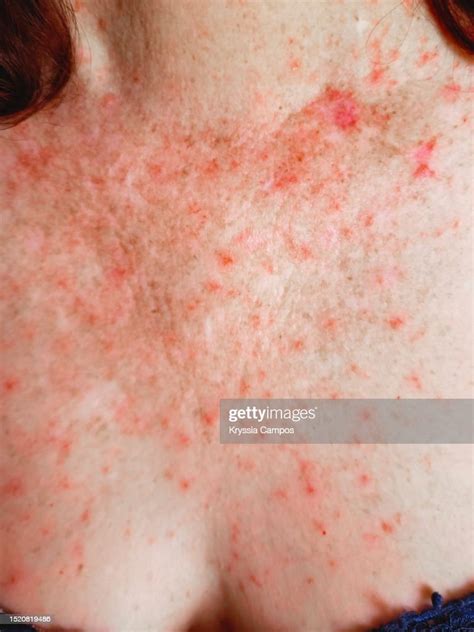 Red Skin Rash With Bumps Scabs Psoriasis Skin High-Res Stock Photo ...