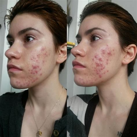 adapalene images  pholder skincare addiction tretinoin