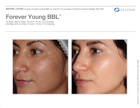 BBL Forever Young | Skin Rejuvenation in Muncie