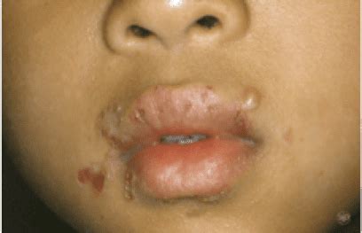 Impetigo: Foothill Dermatology Medical Center: Dermatology