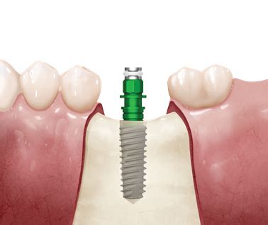 Osstem Implant