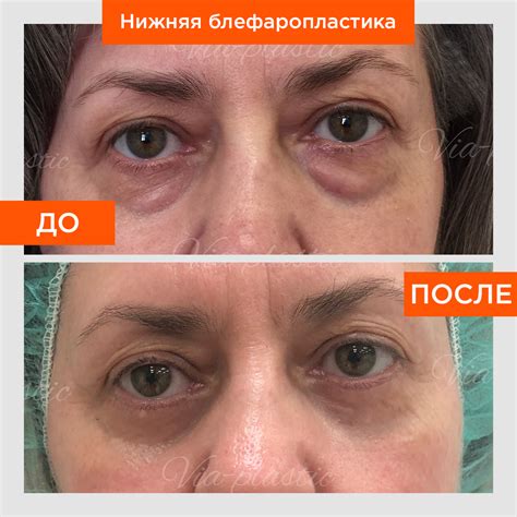 Ботулакс Отзывы Пациентов И Фото Пациентов - Фото Картинки