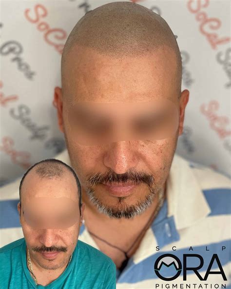 Scalpmora Gallery | Scalp Micropigmentation Transformations in Vista
