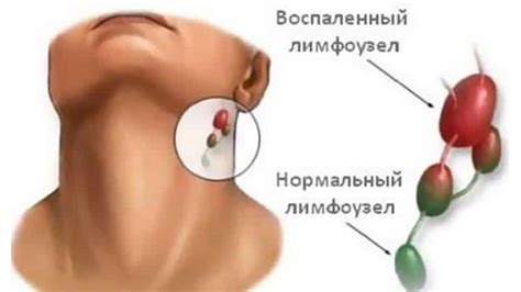 Гнойный бурсит: лечение, симптомы, диагностика
