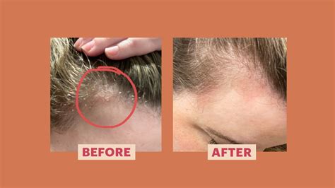 My Scalp Psoriasis Came Out of Nowhere — Here's How I Treated It | Allure