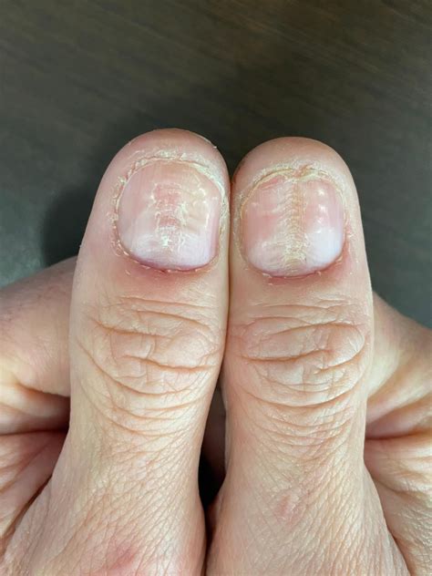 Enfermedad De La Piel Del árbol De Navidad