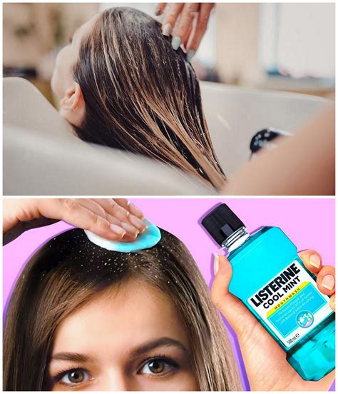 Listerine For Dandruff Treatment | Listerine Foot Soak
