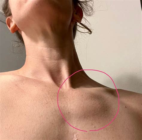 Distention Of The Jugular Veins