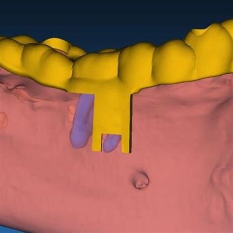 apical resection guide accurate tool  apical resection procedures