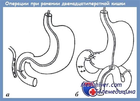 Техника операции при ранении двенадцатиперстной кишки
