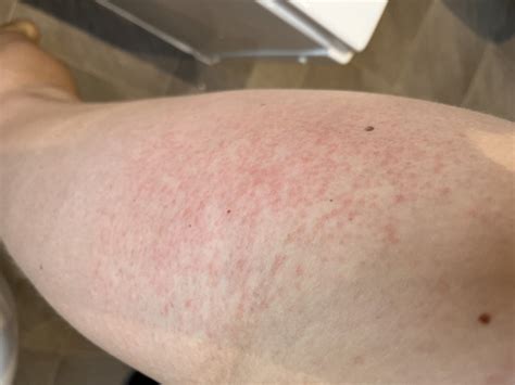 Is this PUPP rash? | Mumsnet