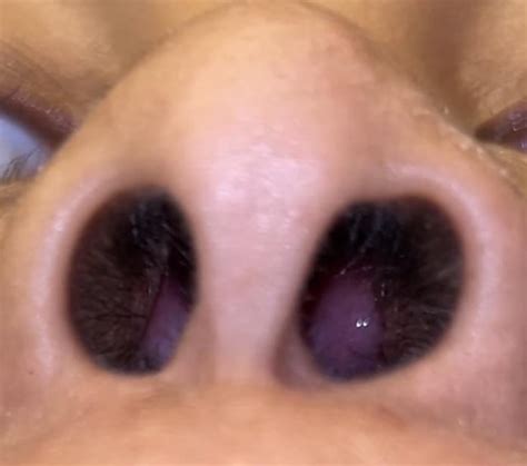 Computer work causing frontal sinus pressure : r/NasalPolyps