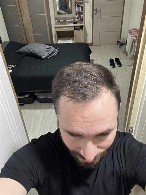 Finasteride and minoxidil - 3 months : r/tressless