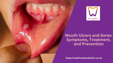 mouth ulcers  sores symptoms treatment  prevention waldron