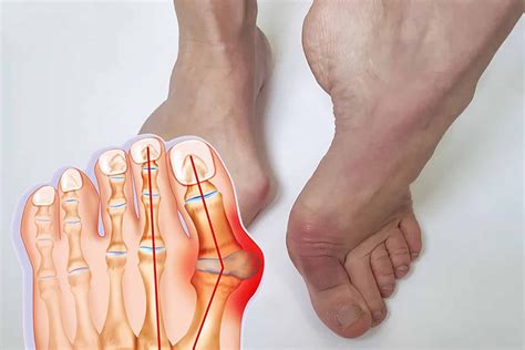 easy treatment prevention  bunions