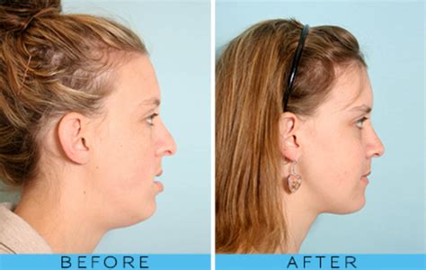 How you breathe can change your face shape - this is what gives you a V ...