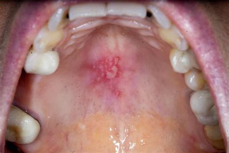 White Sores On Floor Of Mouth | Viewfloor.co