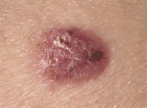 Skin Checks and Skin Cancers | Kangaroo Point Medical Centre