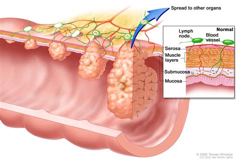 Colon Cancer Stages And Treatment