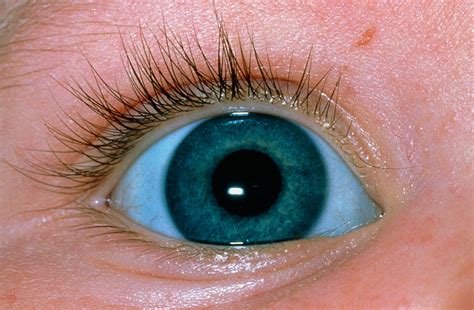 Sclera Disorders