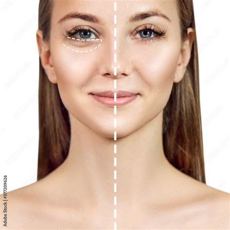 Female face before and after plastic surgery anti wrinkle. Stock Photo ...