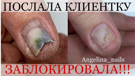 ОНИХОЛИЗИС / ПСЕВДОМОНИЯ / ДЕФОРМАЦИЯ НОГТЕЙ / заблокировала клиентку ...
