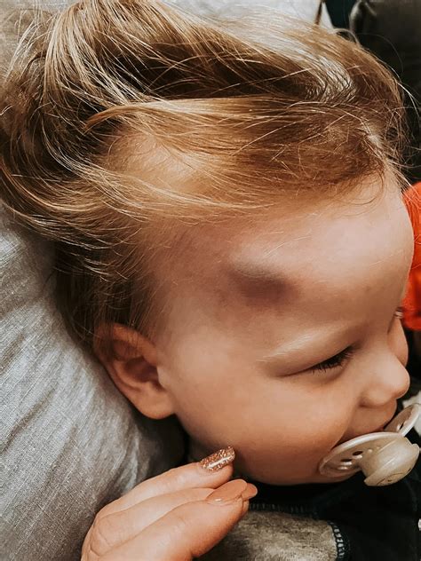 head bump emergency symptoms