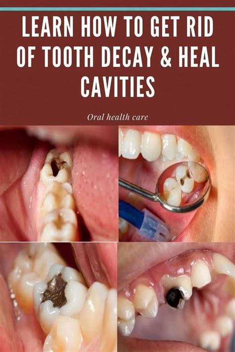 rid  cavities  tooth decay brenda benjamin artofit
