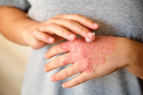 nummular eczema hands treatment