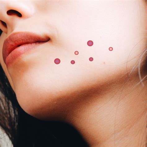 How to Treat Hormonal Acne & What Causes It | Glamour