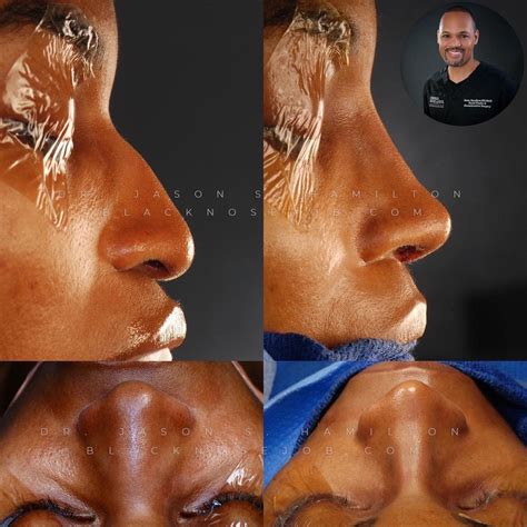 African American Nose