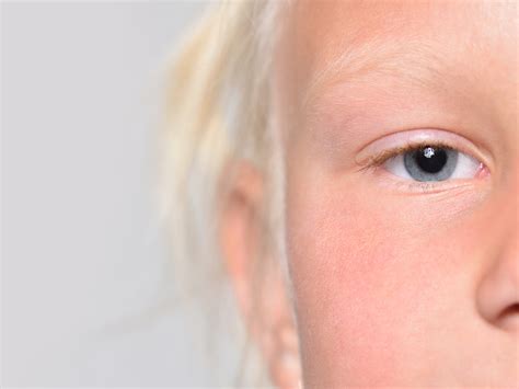 Blind People Eye Color