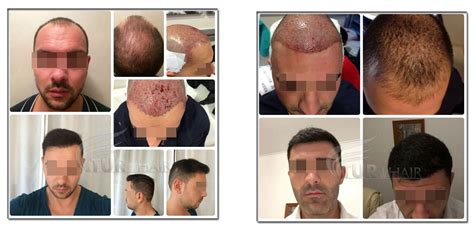 FUE Method - Hair Transplantation in Turkey | TURHAIR | DR DEMIR