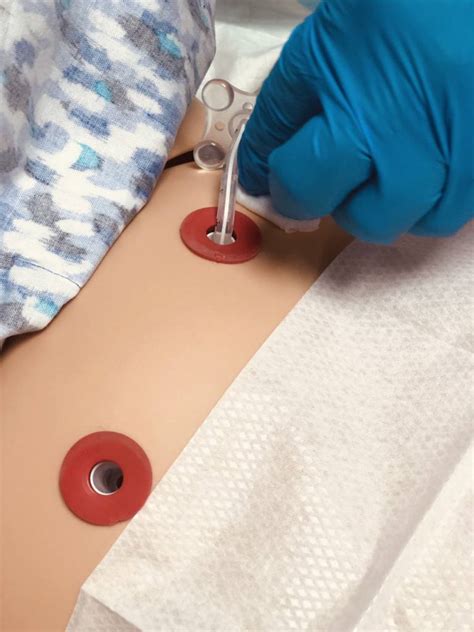 Gastrostomy Stoma