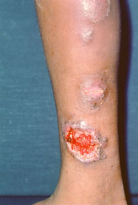 Image:Pyoderma Gangrenosum Ulcerative (Classic) Subtype-Merck Manual