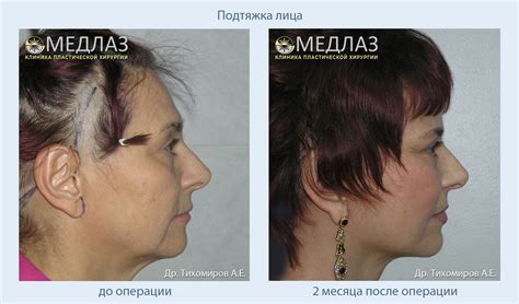Омоложение лица фейслифтингом: Фото до и после в клинике 'МедЛаз', Москва