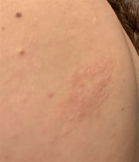 Rash? Eczema? Fungal infection ? : r/AskDocs