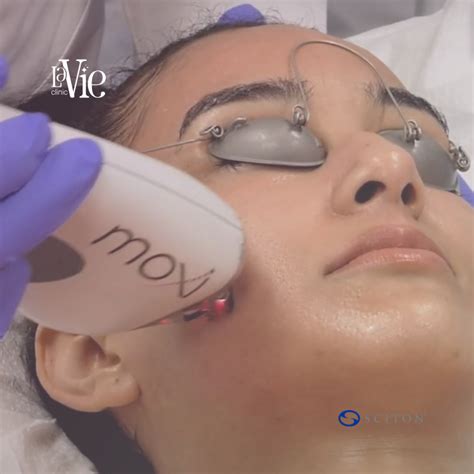 Baby face laser resurfacing