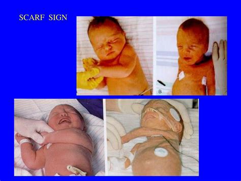 PPT - Same gestational age SGA AGA LGA PowerPoint Presentation, free download - ID:757401