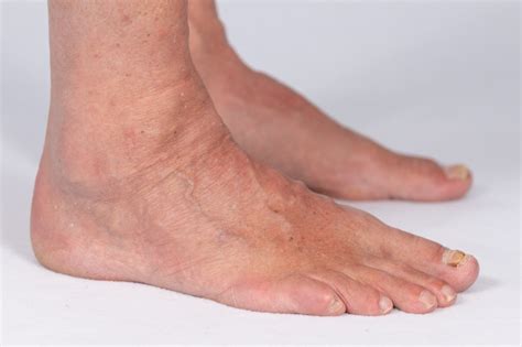 Swollen Ankles Edema In Ankles And Feet — Swollen Feet During