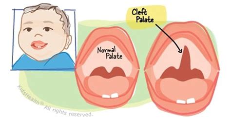 cleft palate