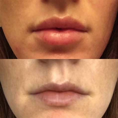 What Does 0.5Ml Lip Filler Look Like at Randy Stambaugh blog