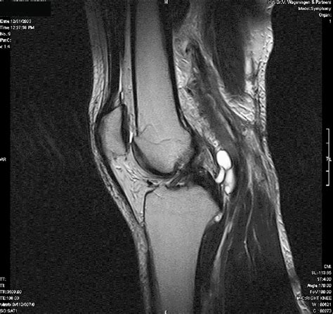 MRI of the right knee showing the lobulated cyst in relation to the ...