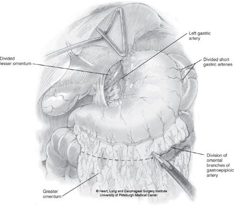 Minimally Invasive Ivor Lewis Esophagectomy | Thoracic Key