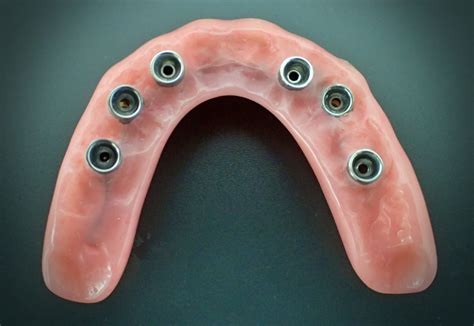 Fixed Maxillary Denture at Walter Reece blog