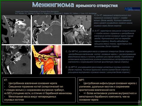 КТ-диагностика опухолей среднего и внутреннего уха