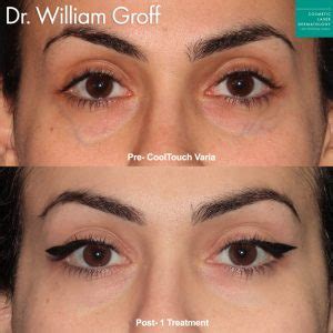 Understanding Under-Eye Veins: Causes, Treatments, and Solutions - Chaztin