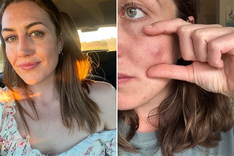 Why popping pimples and cysts is surprisingly addictive for some viewers 7