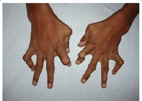 Hand Deformities At Birth